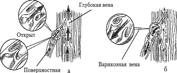 Варикозное расширение вен. Лечение традиционными и нетрадиционными методами